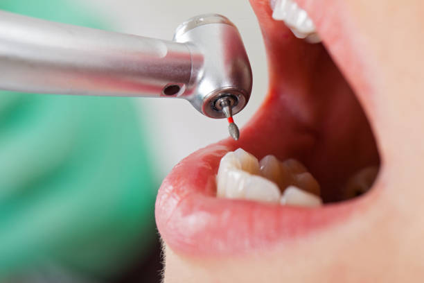 Best Emergency Dental Filling Replacement  in Elba, AL